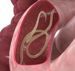 الديدان المستديرة شائعة جدًا في الأمعاء البشرية. 